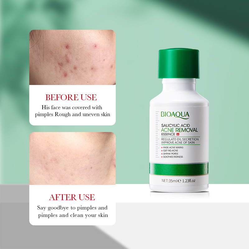 35ml BIOAOUA Kwas salicylowy E – Salicylic Acid Blackhead Remover recenzja i cena
