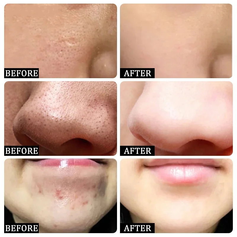 Krem z kwasem salicylowym do o – Salicylic Acid Blackhead Remover recenzja i cena
