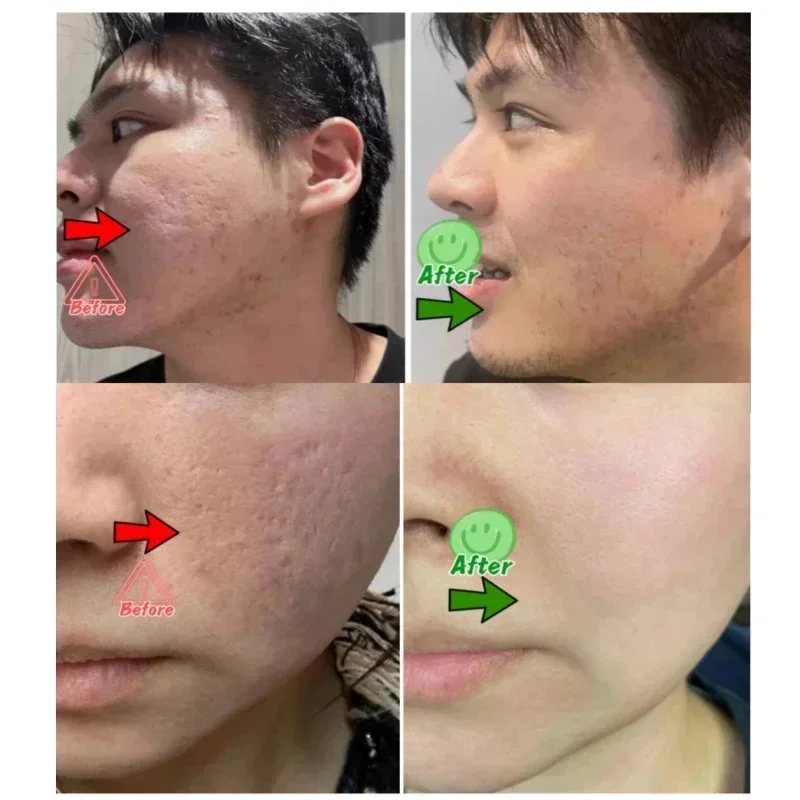 Krem z kwasem salicylowym do o – Salicylic Acid Blackhead Remover recenzja i cena