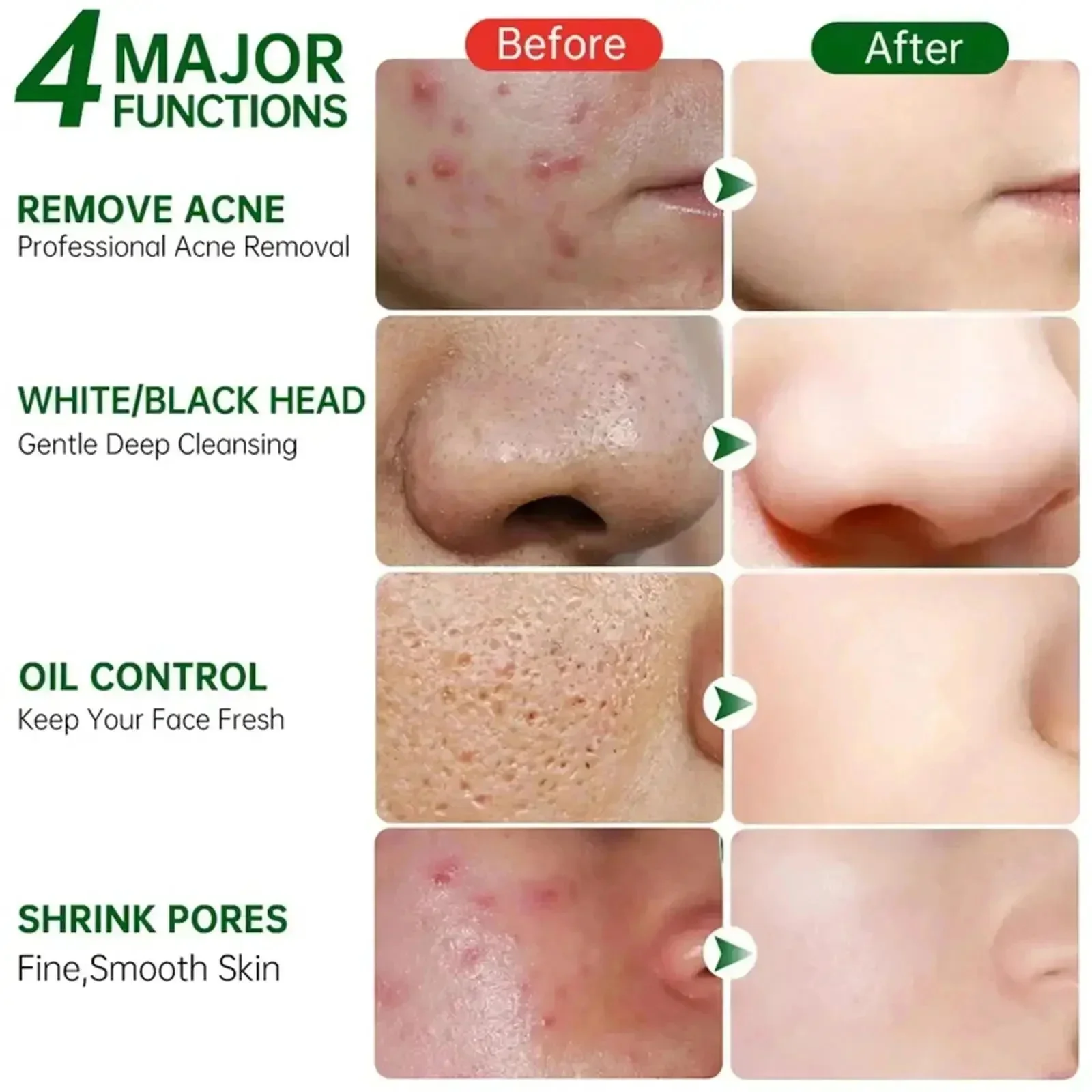 Krem z kwasem salicylowym do o – Salicylic Acid Blackhead Remover recenzja i cena
