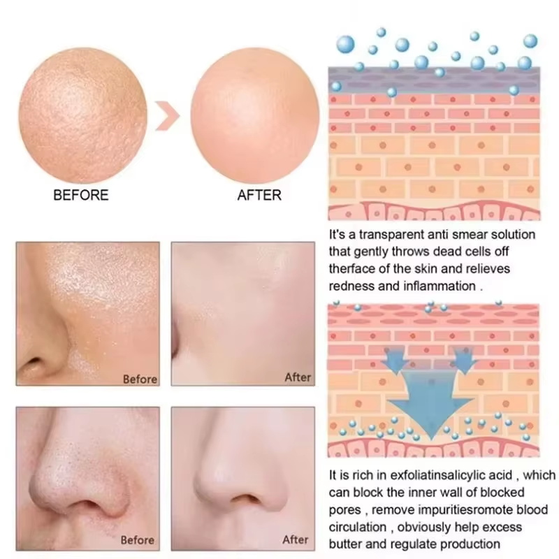 Serum z kwasem salicylowym zwę – Salicylic Acid Blackhead Remover recenzja i cena