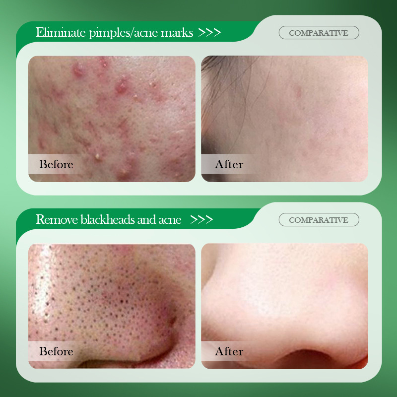 Krem na trądzik z kwasem salic – Salicylic Acid Blackhead Remover recenzja i cena